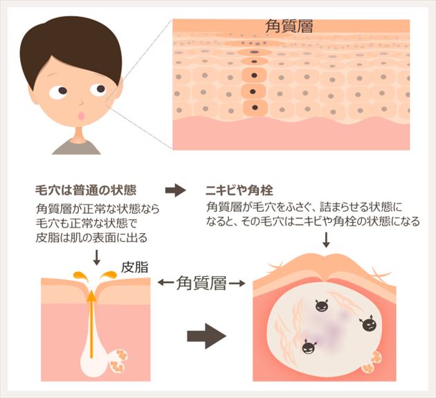 ニキビと角質層