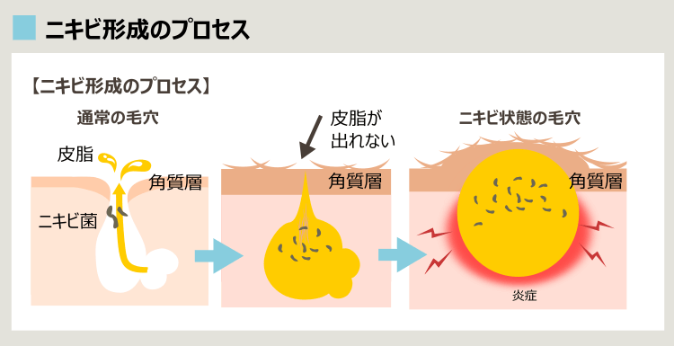 イソトレチノインでニキビを治そう