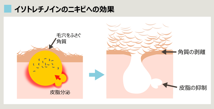 イソトレチノインでニキビを治すプロセス