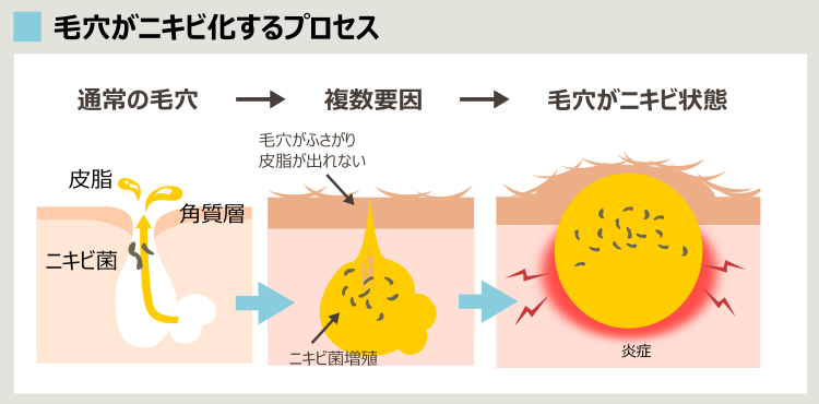 毛穴がニキビ化していくプロセス