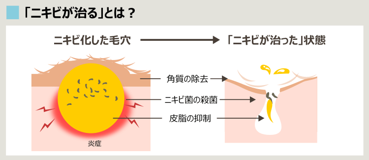 医療的なニキビ治療でできること