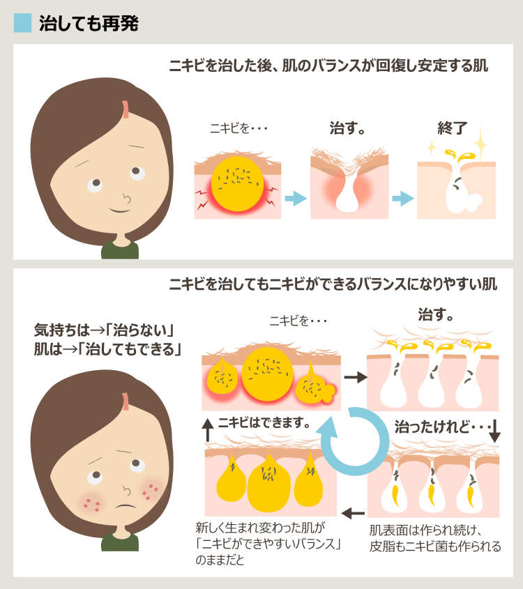 ニキビを治せば終わる肌と、ニキビを治しても再発する肌