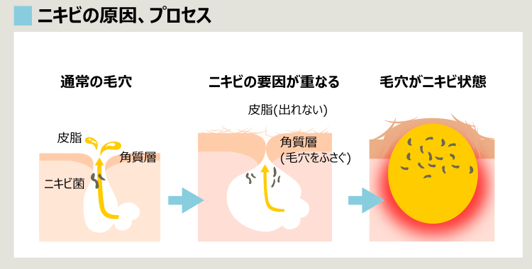 30代でもニキビは同じ