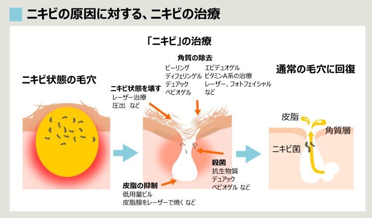 様々な大人ニキビの治療法