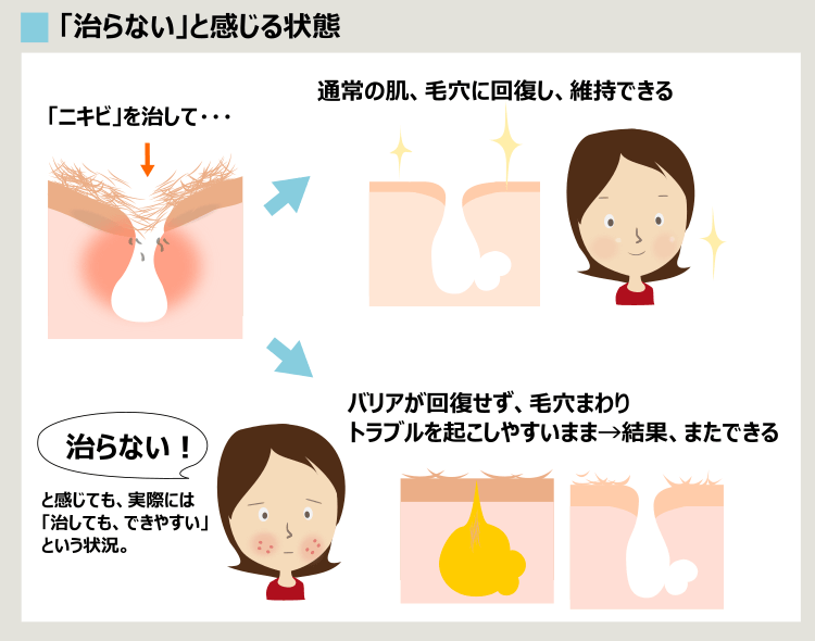 ニキビ治療が効かず、ニキビをくり返す理由