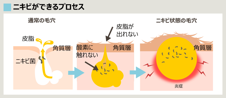 ニキビができるプロセス