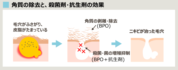 デュアックでニキビが治るプロセス