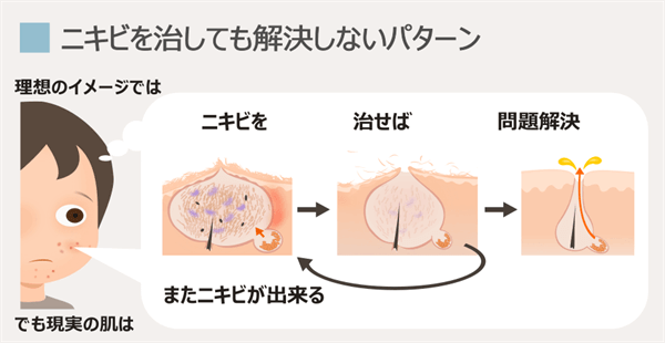 ニキビケアは一時的なニキビなら効果があるかもしれない