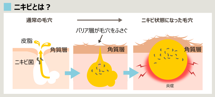 角質層が毛穴をふさぐニキビ形成プロセス