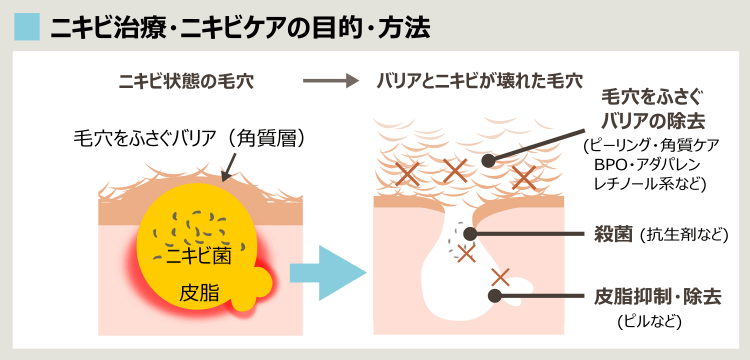 ピーリング的なニキビ治療やニキビケアがニキビを治す理由
