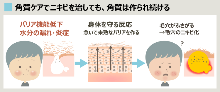 角質層の循環とニキビの再発くり返しの関連