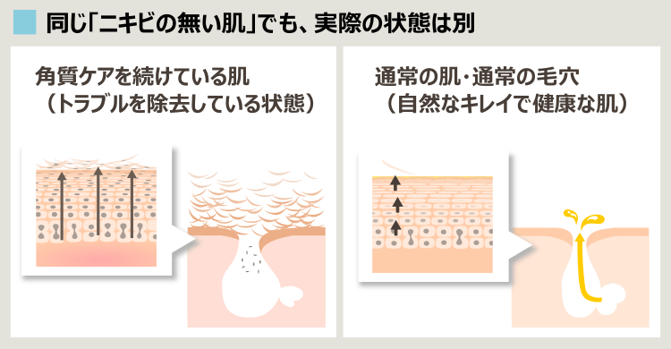 ニキビを治すことと、肌がキレイになることの違い