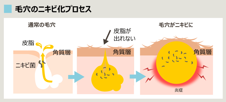ニキビができる過程