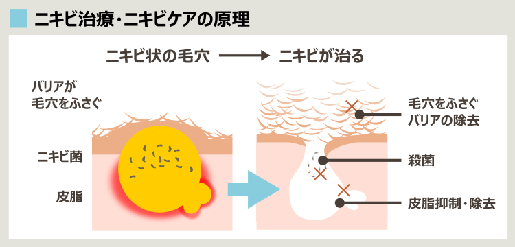 「ニキビを治す」方法