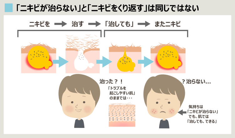 ニキビは治ってもくり返すことがあるトラブル