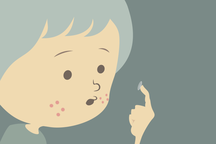 1週間でニキビ完治のニキビパッチ