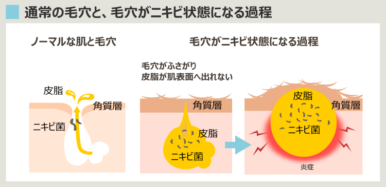 毛穴のニキビ化の過程