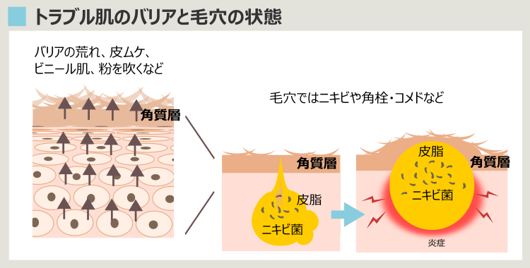 トラブル肌のバリアと毛穴