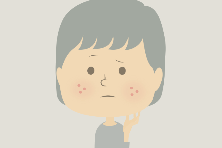 ニキビに悩まない肌。どうすれば?