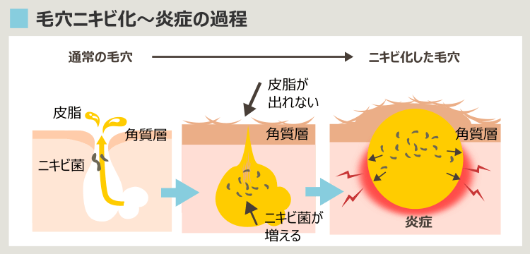 毛穴がニキビ化するプロセス