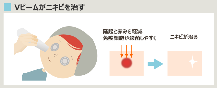 Vビームによるニキビ治療