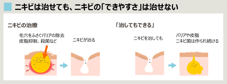 ニキビのくり返しはなぜ起きるのか？