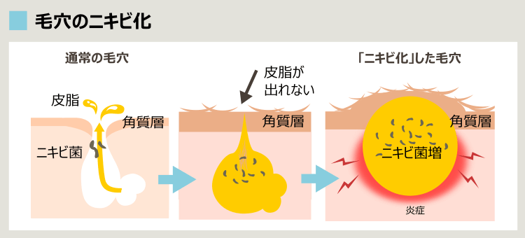毛穴のニキビ化
