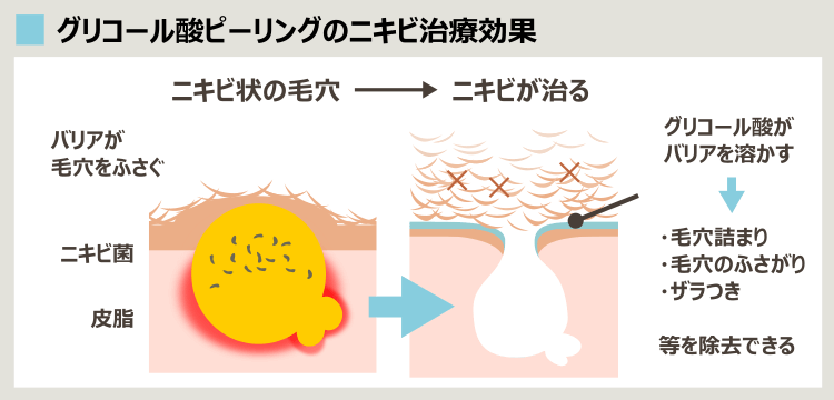 グリコール酸のニキビ治療効果