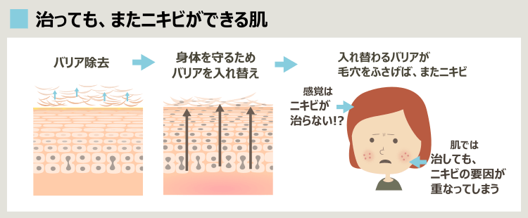 グリコール酸ピーリングによるニキビ治療と、実際のニキビ