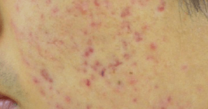 acne-scars