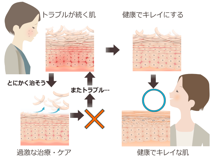 ニキビ跡をくり返すメカニズム