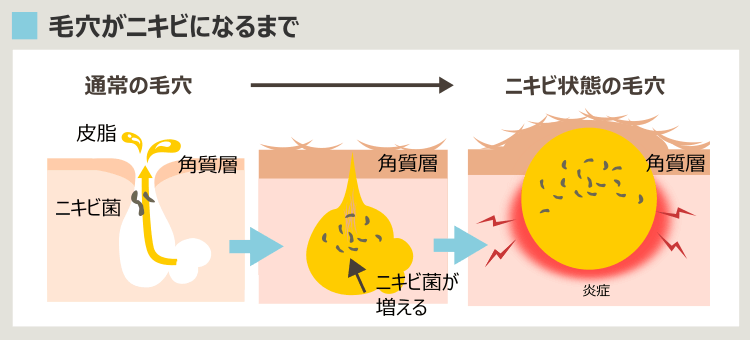 毛穴がニキビになる過程