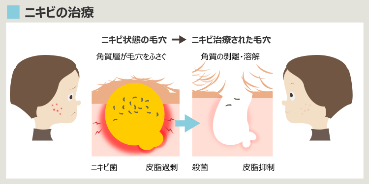 ニキビの原因に合わせたニキビ治療