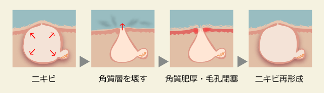 ピーリングは「ニキビのくり返し」と止める方法ではない