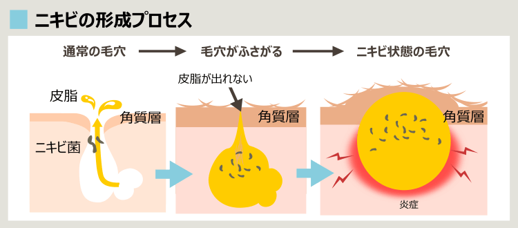 毛穴がニキビになっていく過程