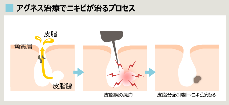 アグネス治療でニキビが完治するのか？