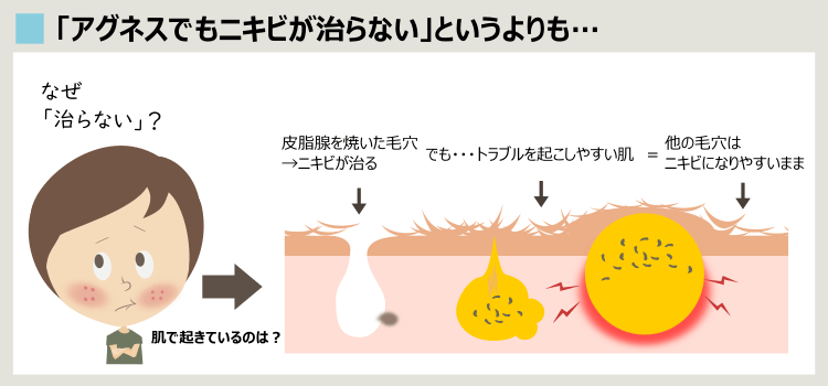 アグネス治療をしていても、ニキビが慢性化する理由