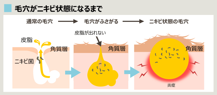 毛穴がニキビになるまで