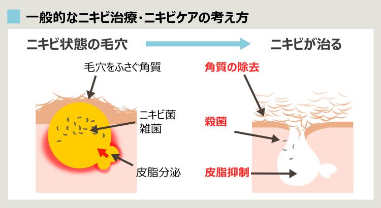 ニキビの標準治療概要