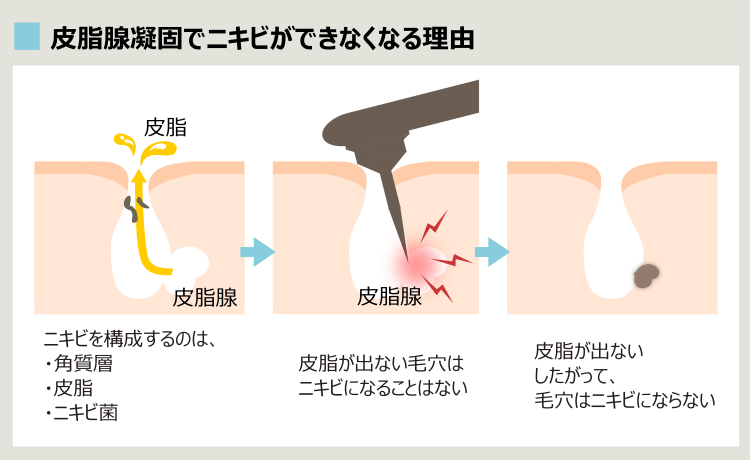 皮脂腺凝固法やアグネス治療のニキビへのアプローチ