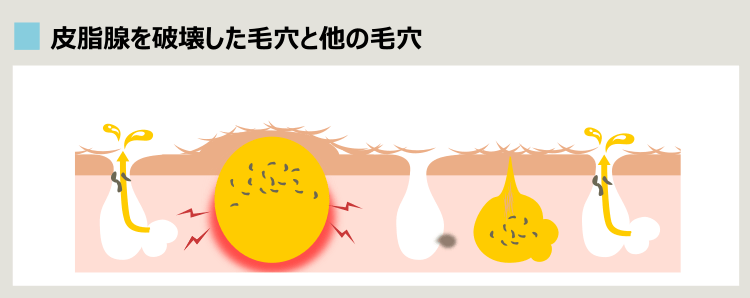 皮脂腺凝固法やアグネス治療の効果が出た毛穴と治療してない毛穴