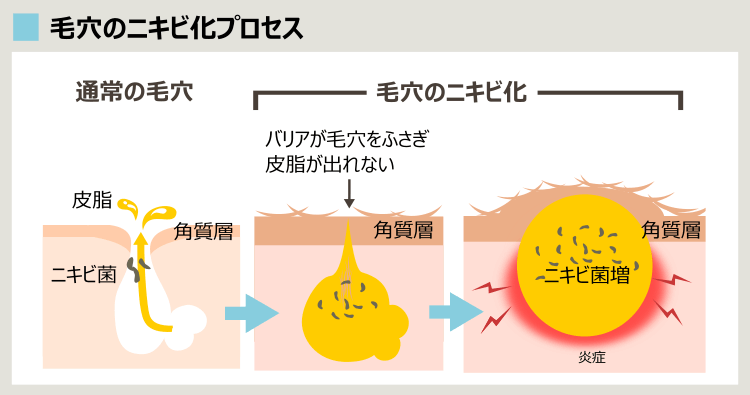 毛穴がニキビになっていく過程