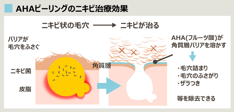 AHAピーリングでニキビが治る理由