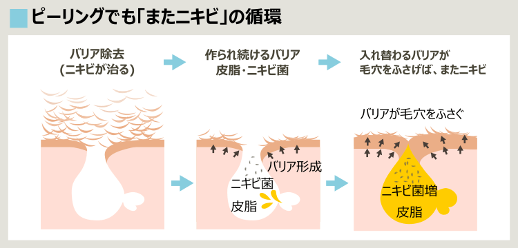 AHAピーリングでニキビを治してもまたできる理由