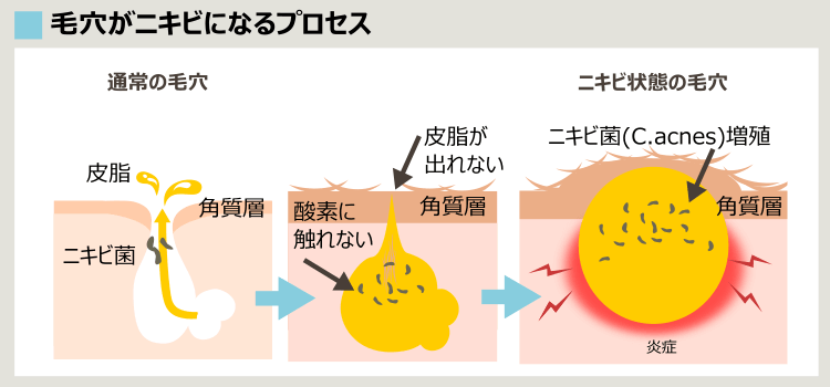 ニキビ形成プロセスとニキビ菌