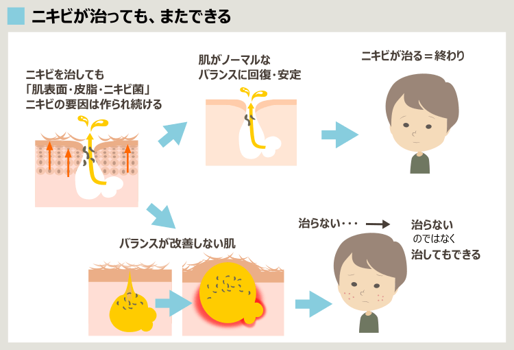 抗生剤で治しても、ニキビをくり返す理由