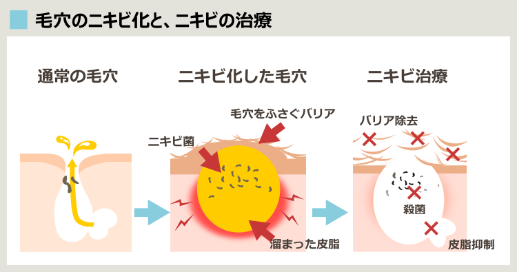ニキビとニキビ治療