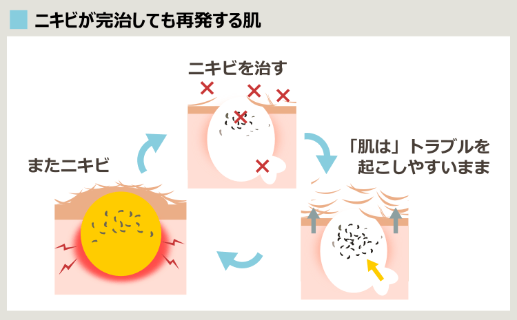 ニキビをくり返す肌の循環