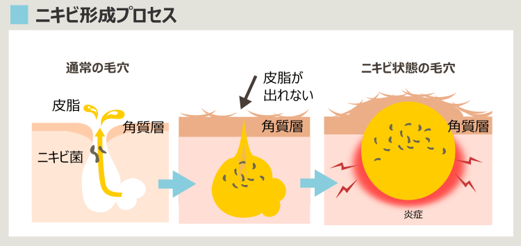 毛穴がニキビになるプロセス