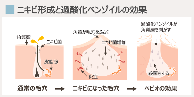 ニキビ形成とベピオ・過酸化ベンゾイルの効き目